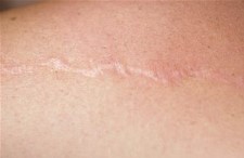 Tips caseros para borrar las cicatrices de la piel