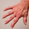 Combatir la artrosis